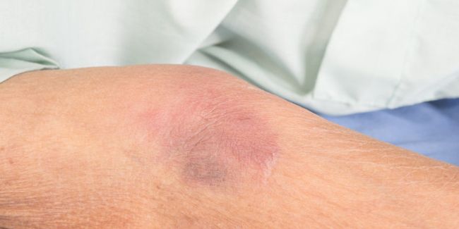 L'hématome sous-dural chez les personnes âgées : un danger bien réel