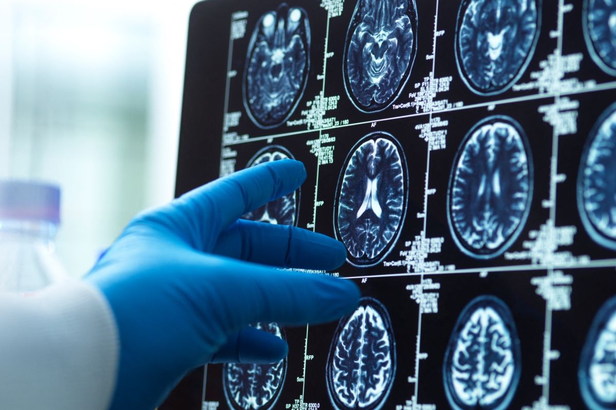 Comment votre assiette peut influencer votre risque d'Alzheimer