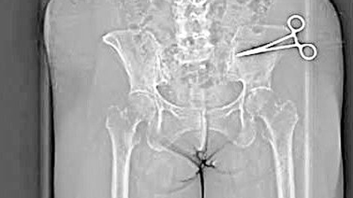 Une femme vit avec des ciseaux dans le ventre après une chirurgie esthétique ratée